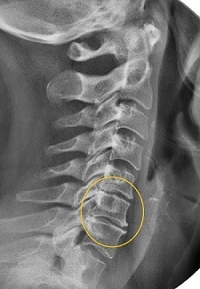 Narrowing of the intervertebral space on radiography