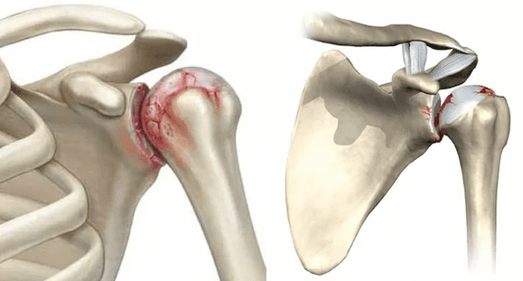 how is arthrosis of the shoulder joint