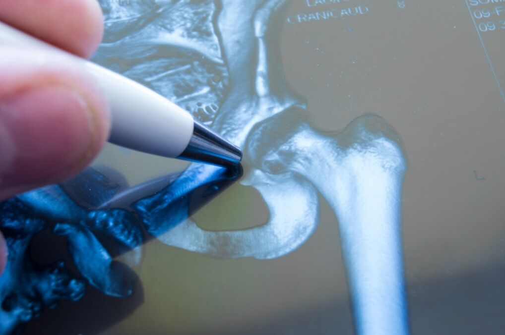 Arthrosis of the hip joint on radiograph
