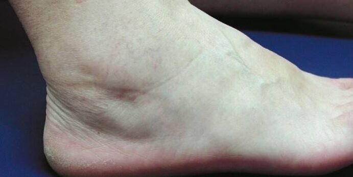 ankle swelling with arthrosis