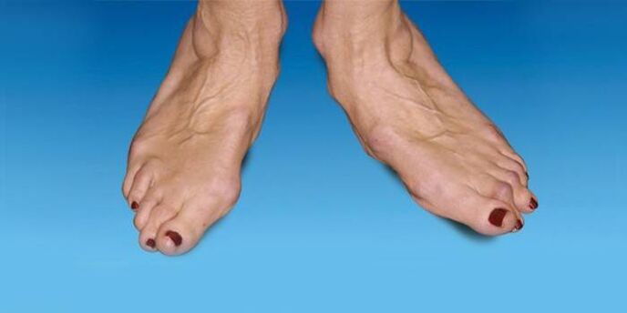 foot deformity with ankle arthrosis