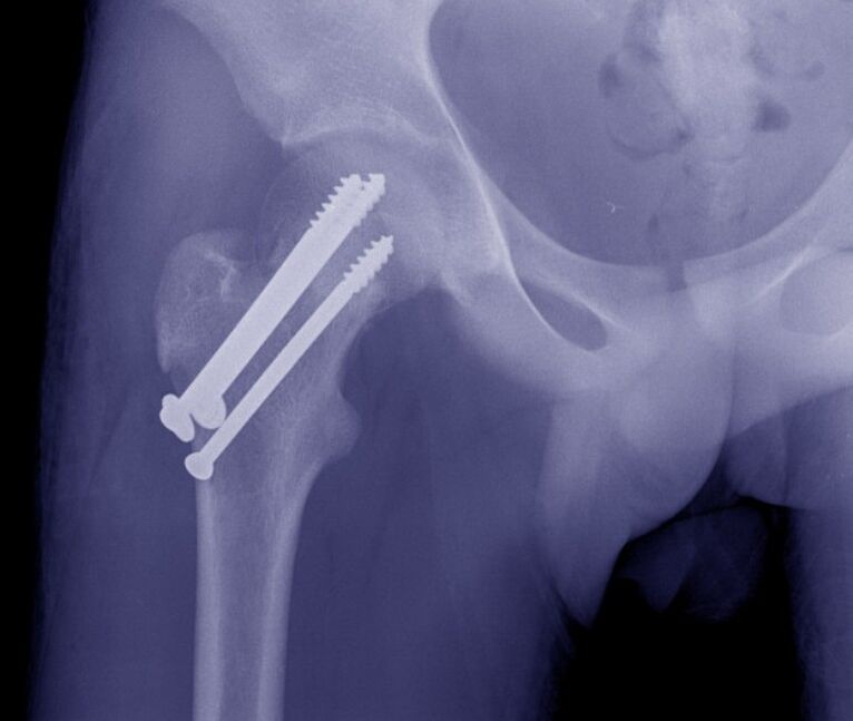 Hip joint X-ray, fracture osteosynthesis with internal fixation devices