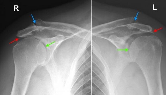 X-ray of shoulder joints