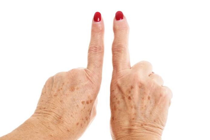 deforming arthrosis in fingers