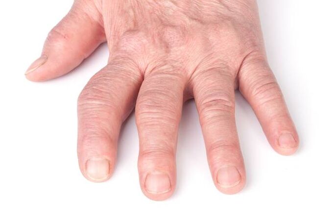 deforming arthrosis in the hands
