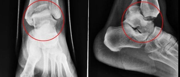 X-ray for ankle arthrosis