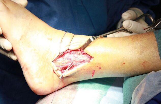 ankle arthrosis surgery