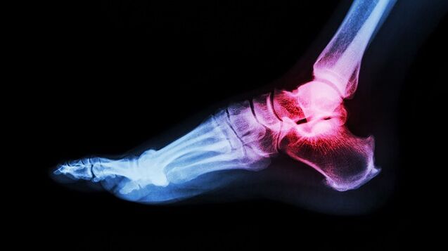 ankle arthrosis