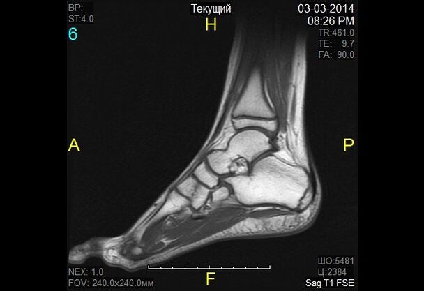 ankle image for osteoarthritis