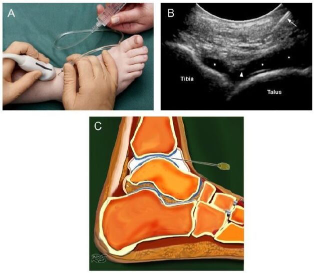 ultrasound of the ankle joint with arthrosis