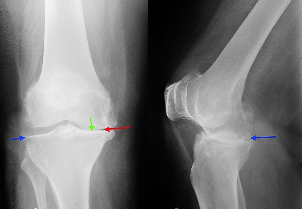 x-ray of arthrosis of the knee joint