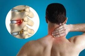 Pinching from vertebrae