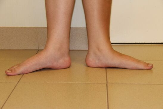 Sometimes the cause of neck osteoarthritis is flat feet
