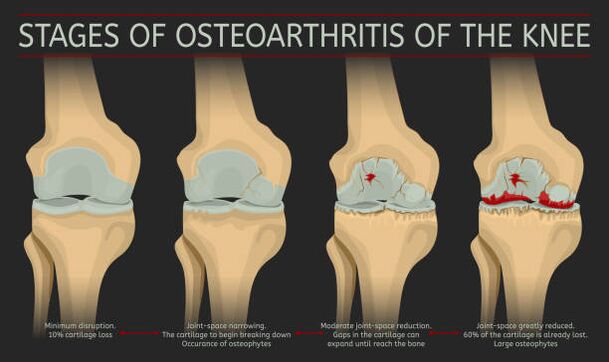 development of joint arthrosis